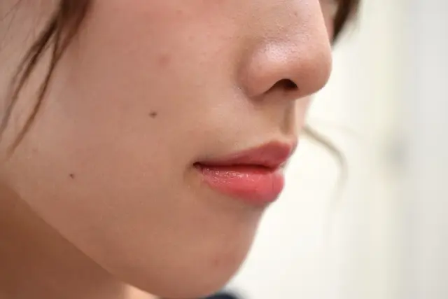 顔のほくろはなぜできる？ほくろの原因と除去方法を紹介